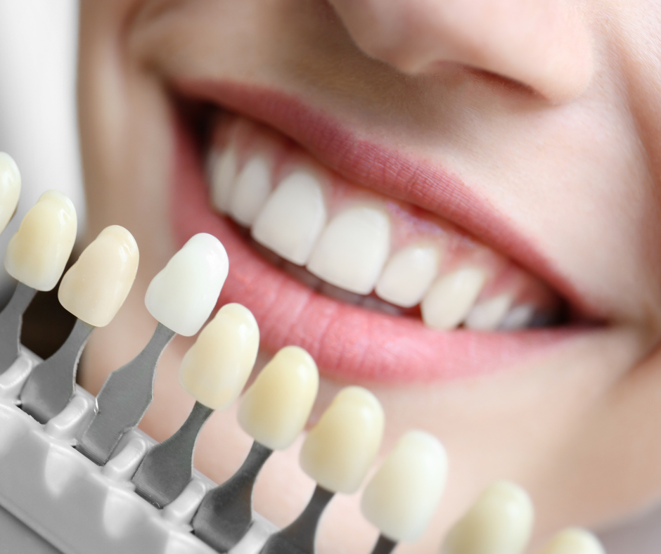 Safe Teeth Whitening Tips: Dentist-Approved Guide