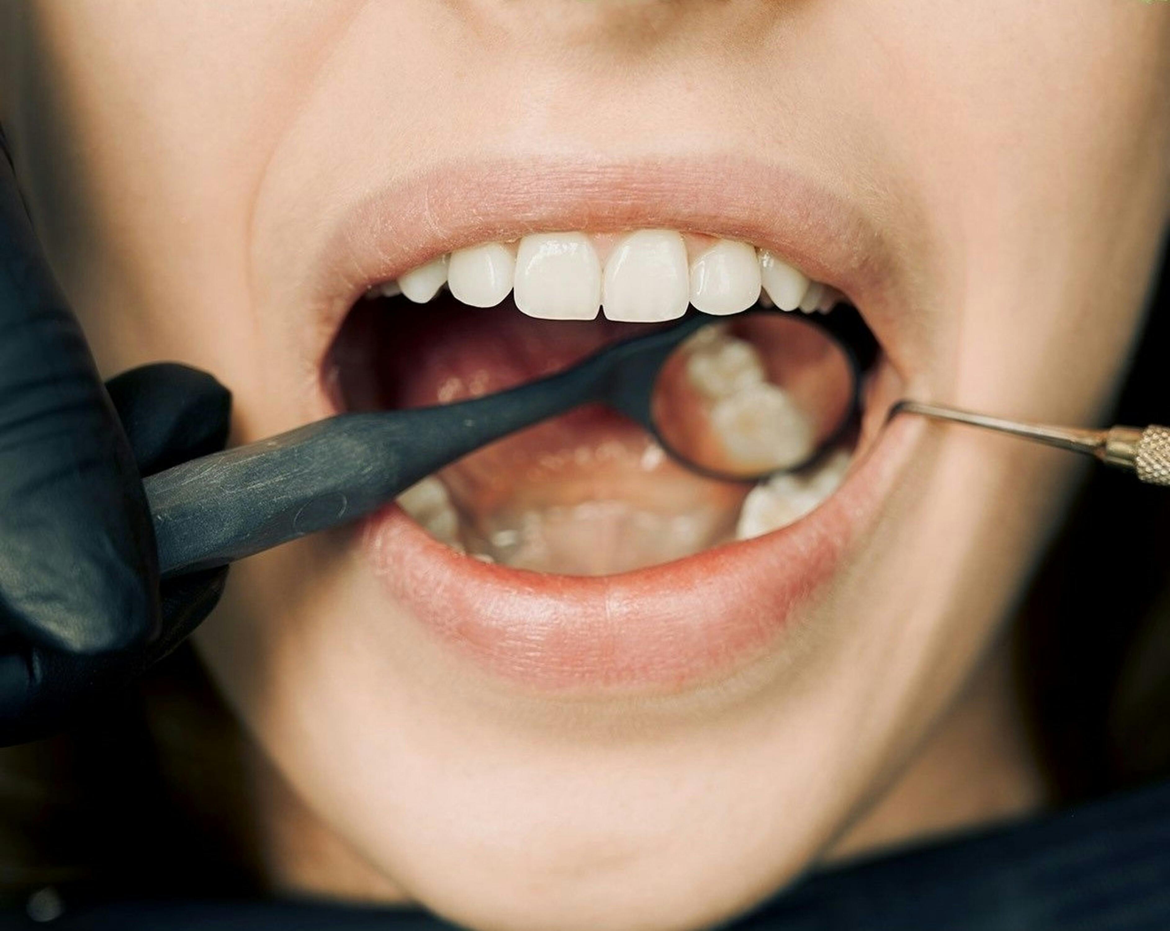 How To Prevent Cavities and Protect Your Teeth