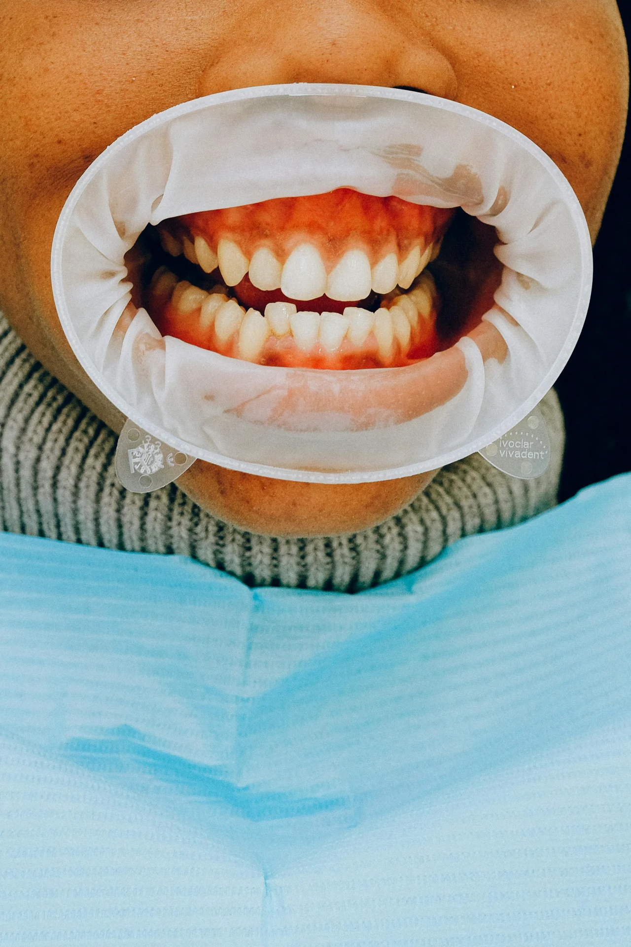 Surgical vs. Non-Surgical Gum Recession Solutions: A Complete Treatment Guide