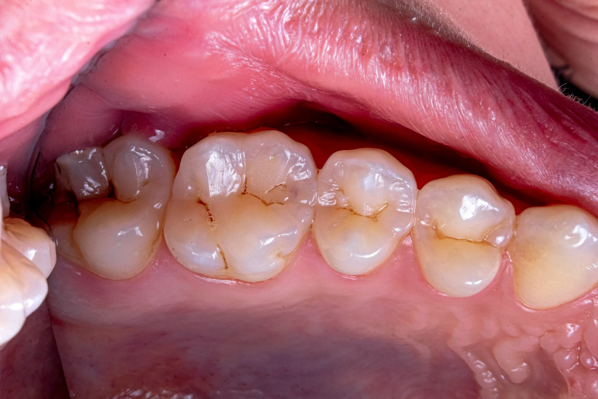 Common Causes of Gum Swelling Explained