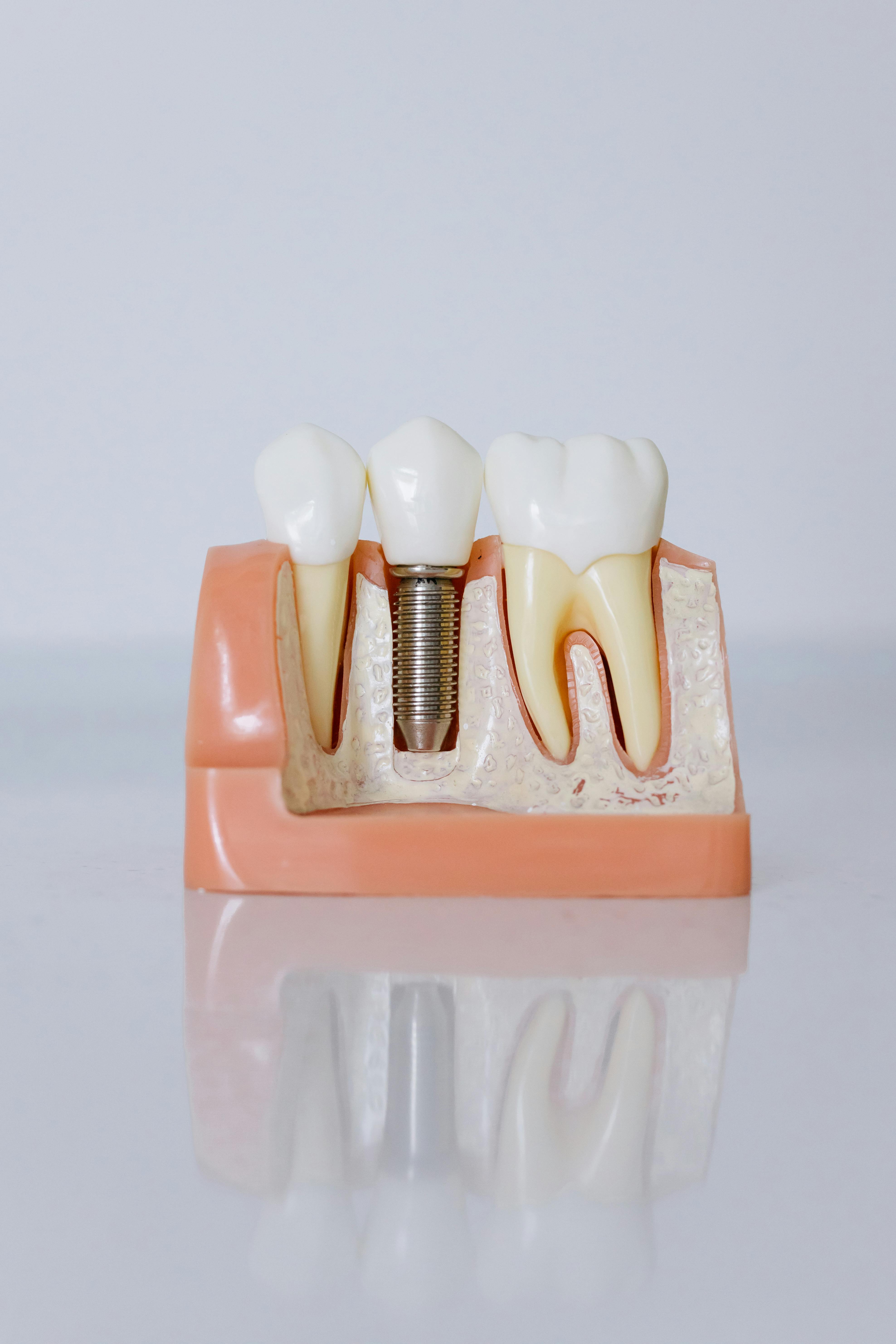 Dental Implant Treatment Planning for Dental Professionals and Patients