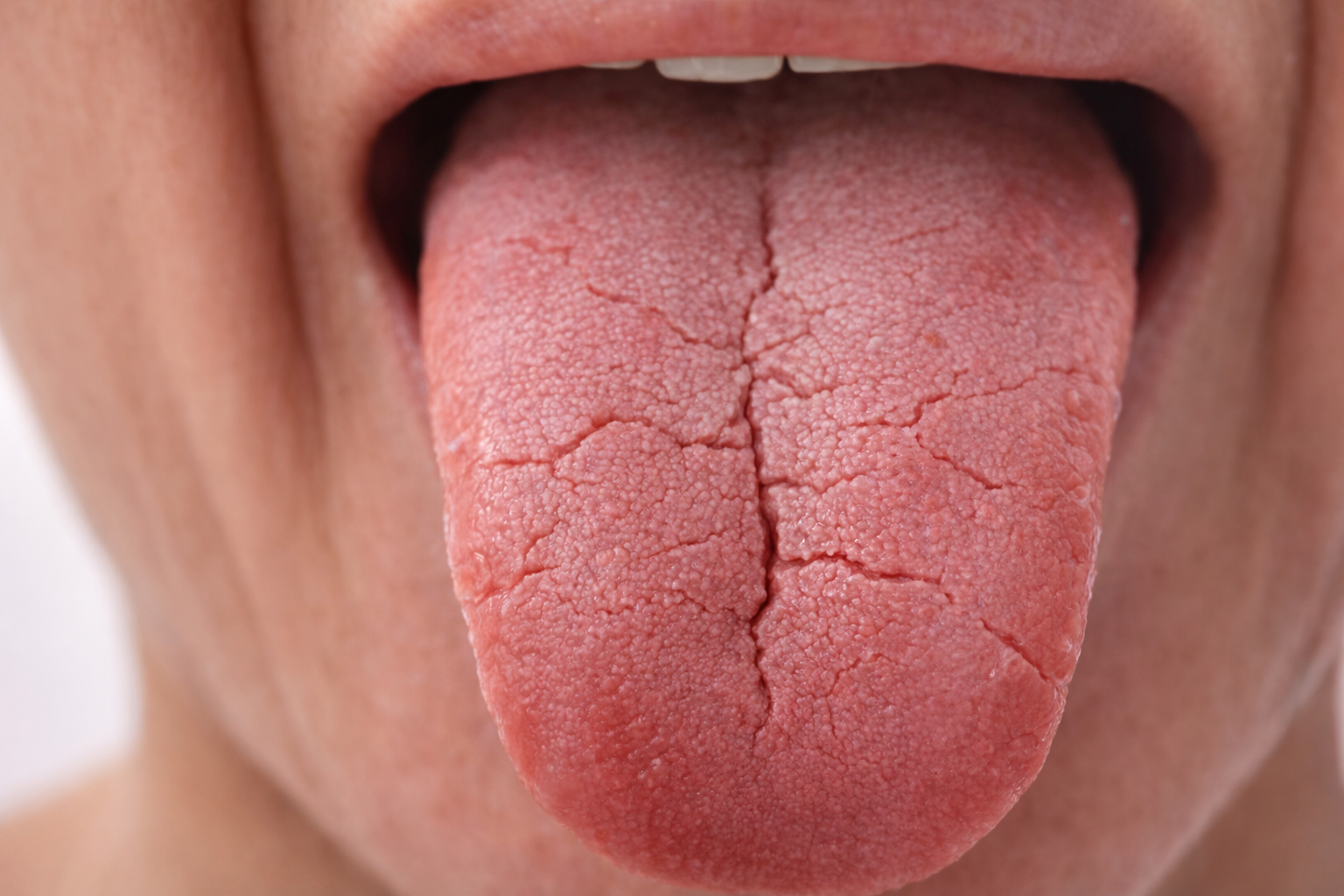 Cracks on Tongue and Vitamin Deficiency: Causes, Treatments, and  Tips