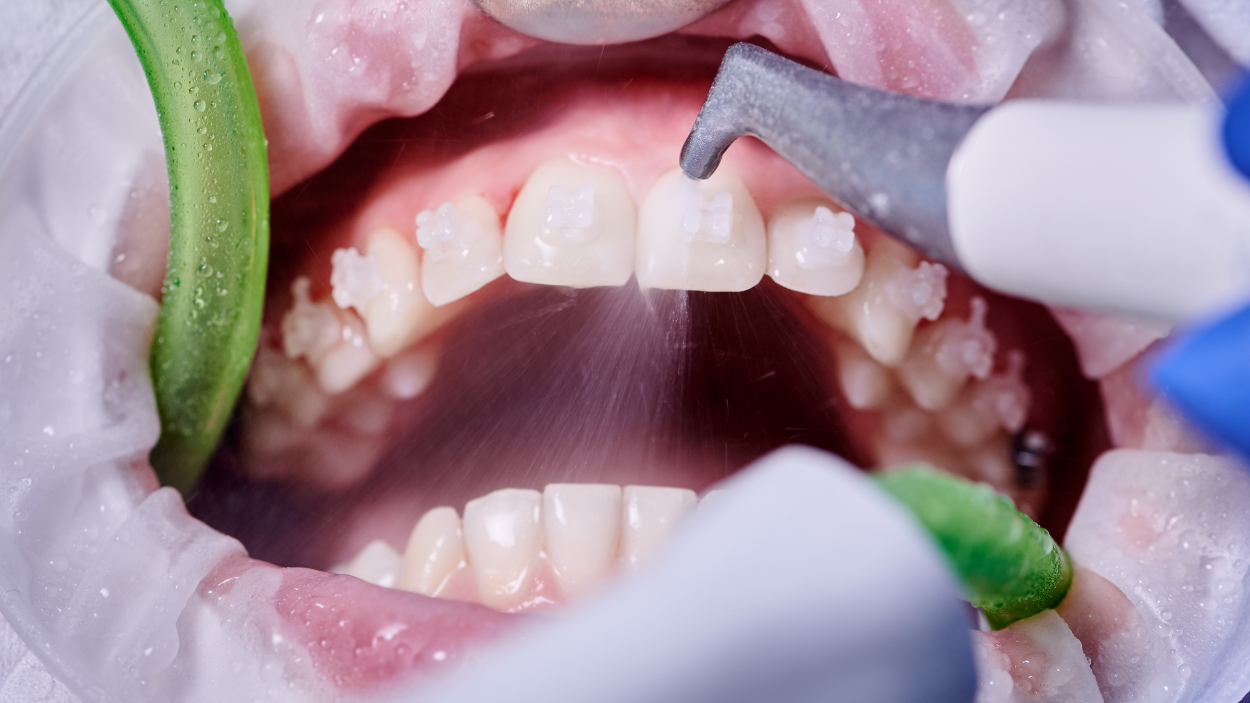 How Much Does Dental Deep Cleaning Cost in the US?