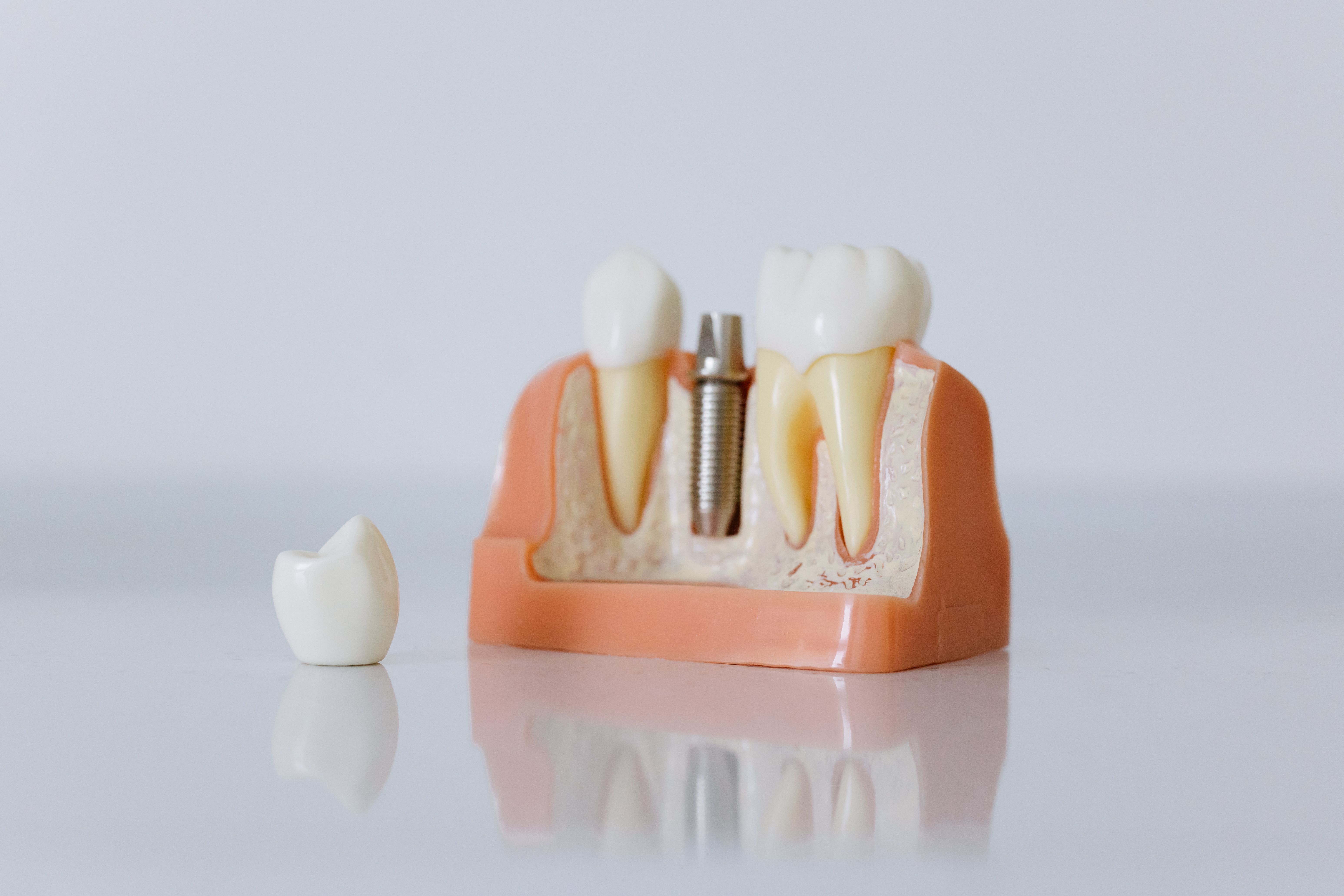 Neodent Dental Implants: Cost, Quality, And Reviews Explained