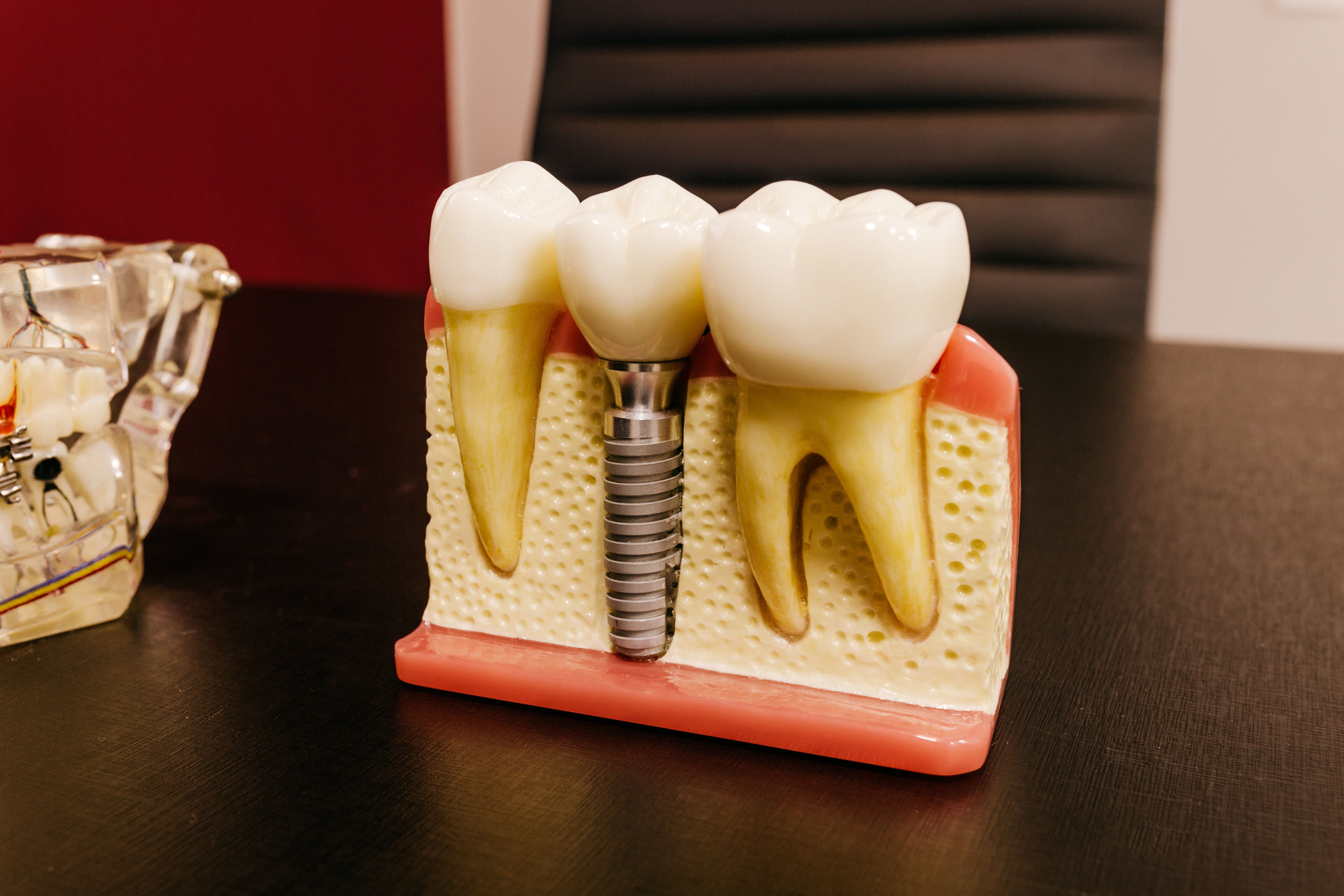 Dentist Answers: How Much Are Dental Implants?