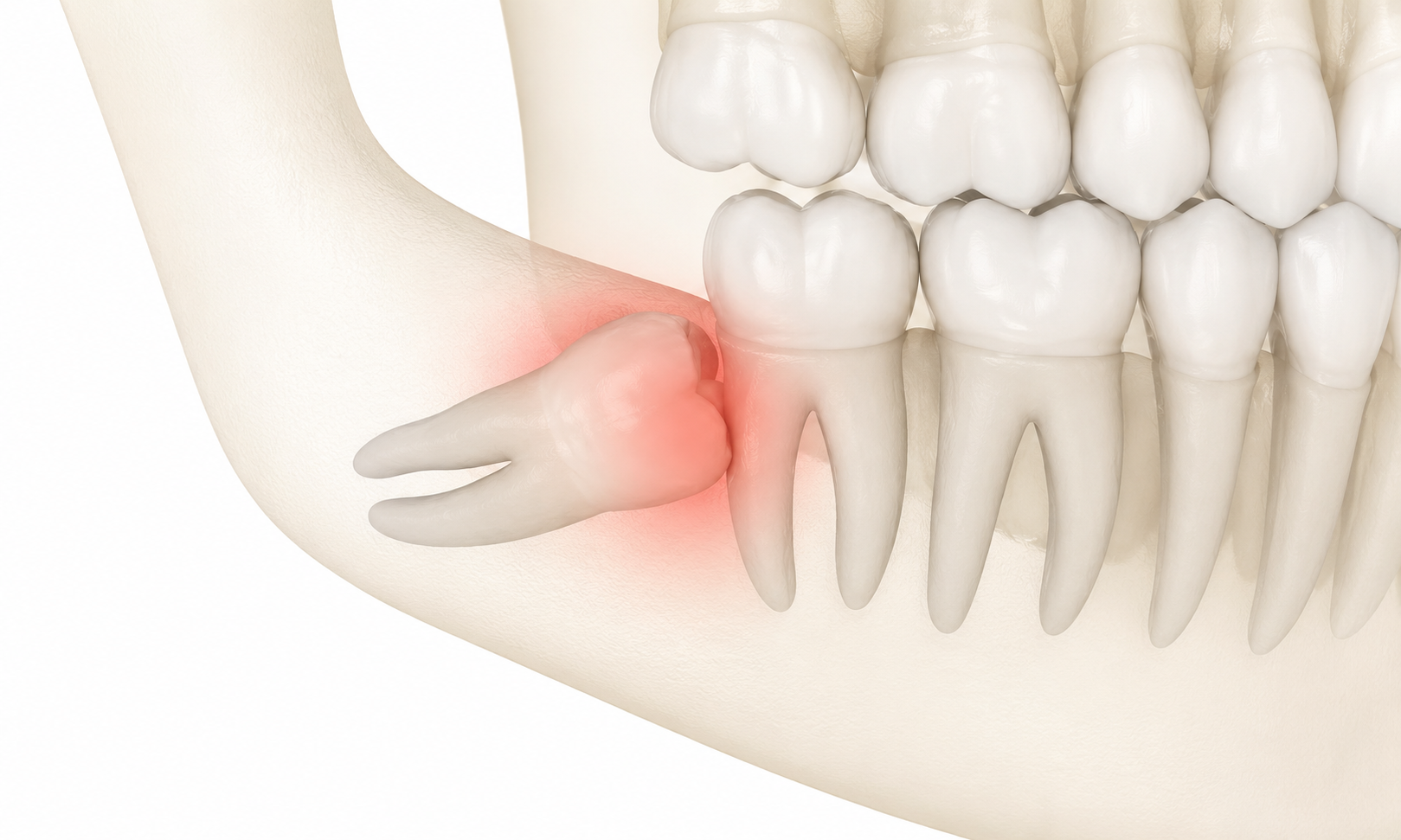 Impacted Wisdom Tooth: Symptoms, Types, and Healing Time