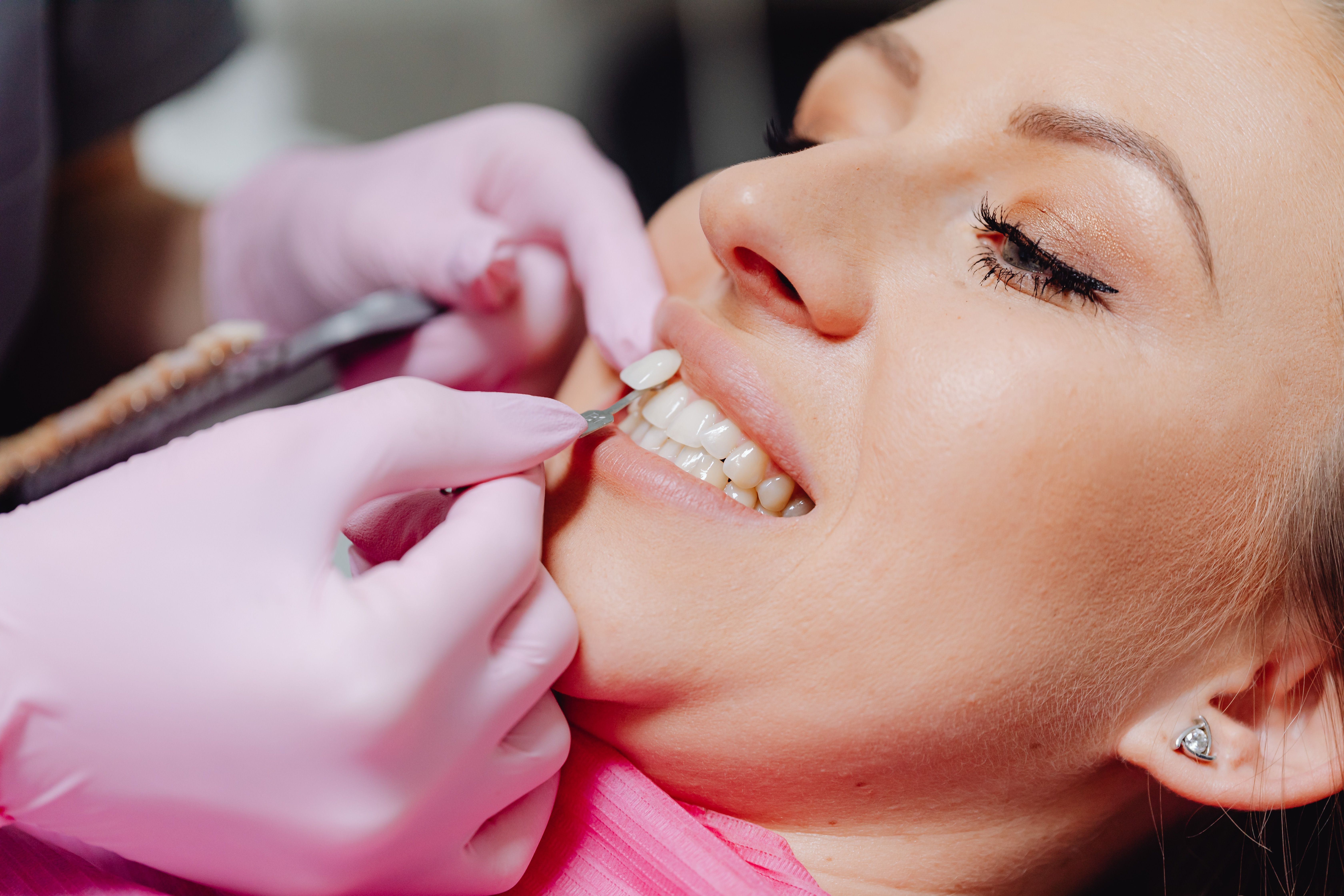 Veneers Cost by Tooth, Material, and State
