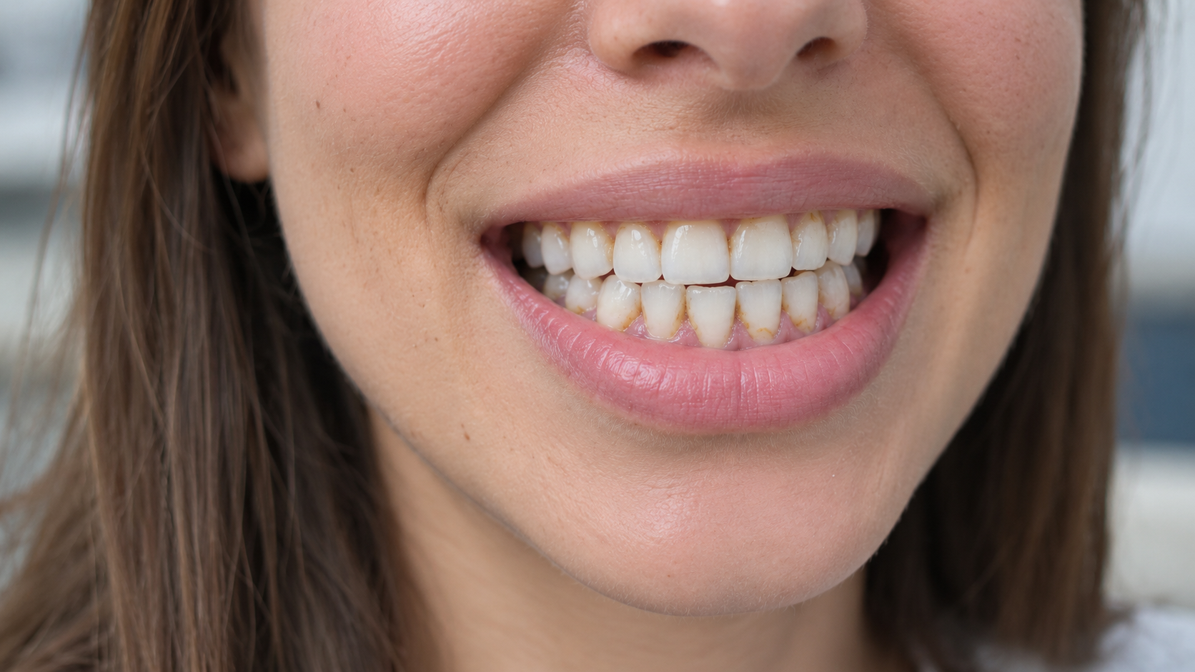 Calculus Bridge On Teeth: Causes, Removal, And Cost