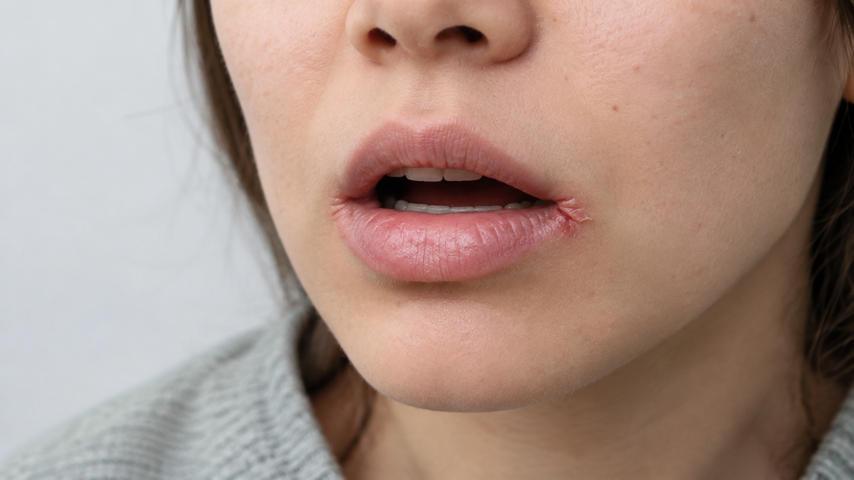 Angular Cheilitis: Why It Happens and How A Dentist Treats It