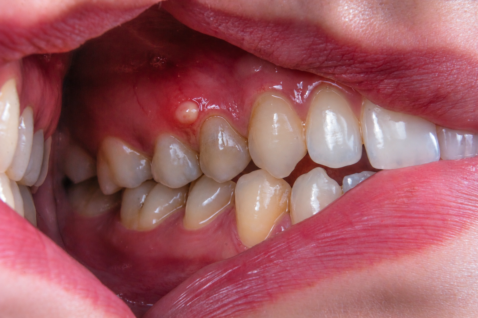 Tooth Abscess: Signs, Causes, And Treatment