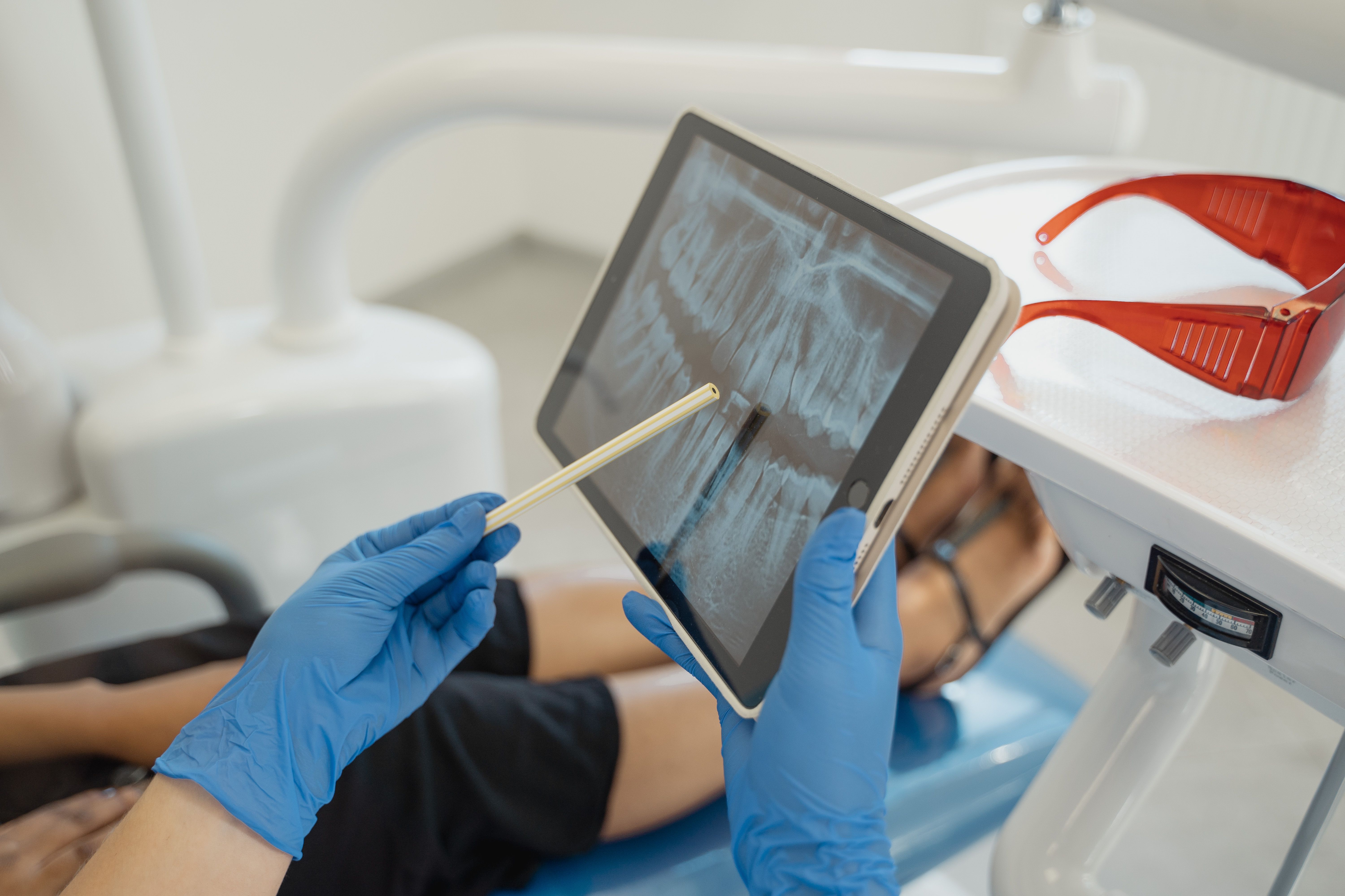 Dentist Answers: Can A Root Canal Fail Years Later?