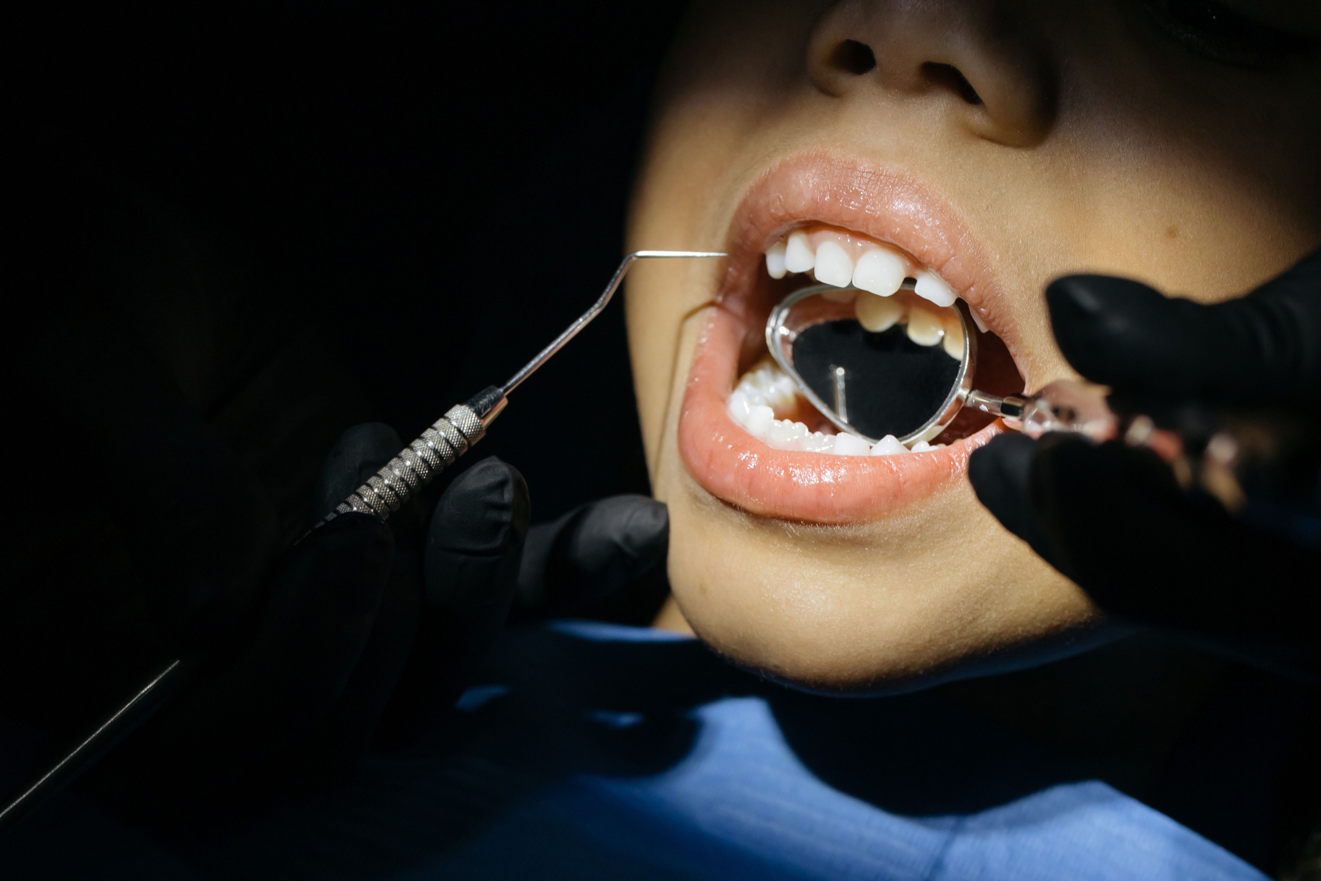New Clinical Trial Compares Treatments for Cavities in Baby Teeth
