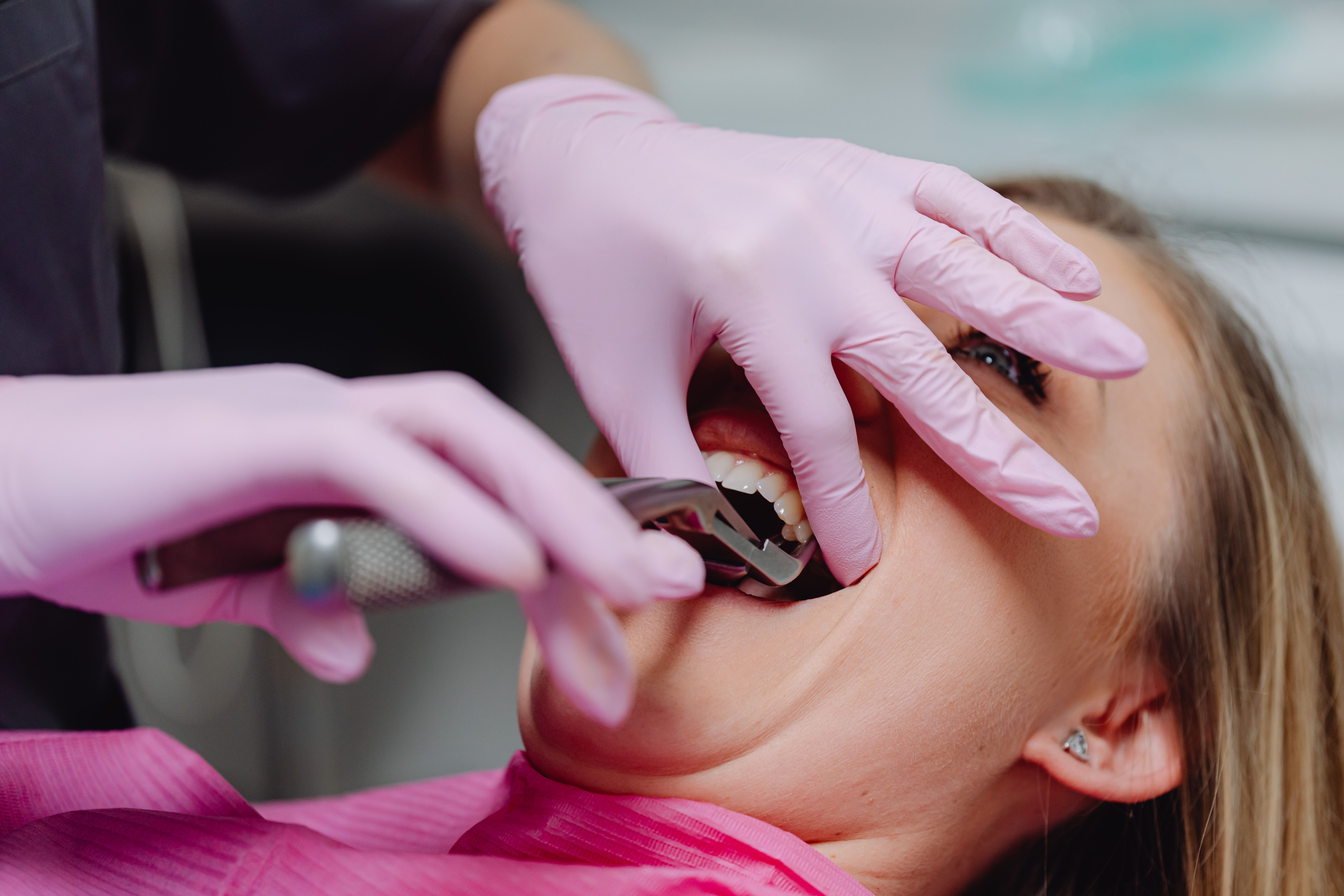 Bone Spicule After Tooth Extraction: Symptoms, Healing, and Removal