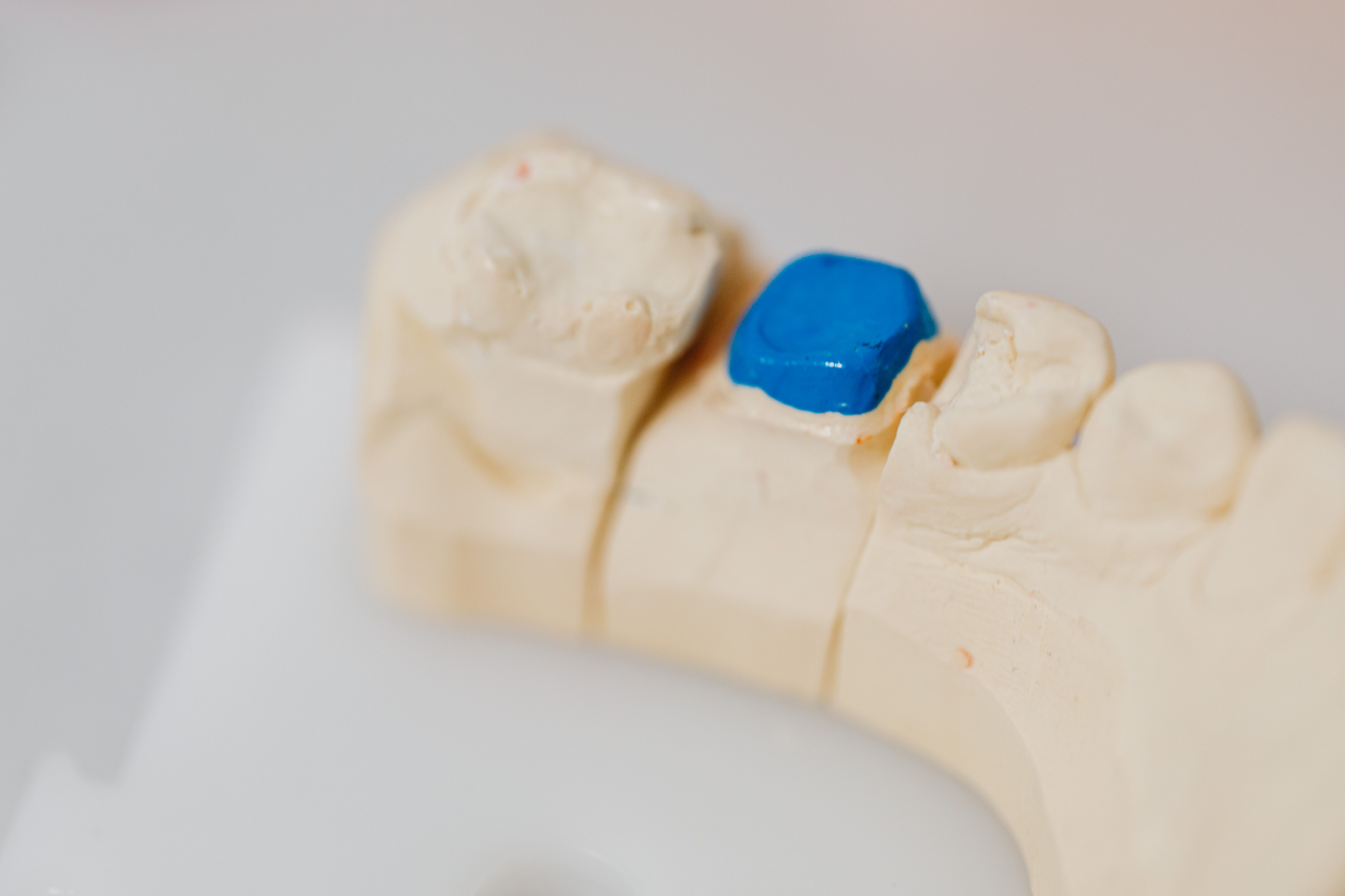 Temporary Filling Fell Out? What to Do Before Seeing a Dentist