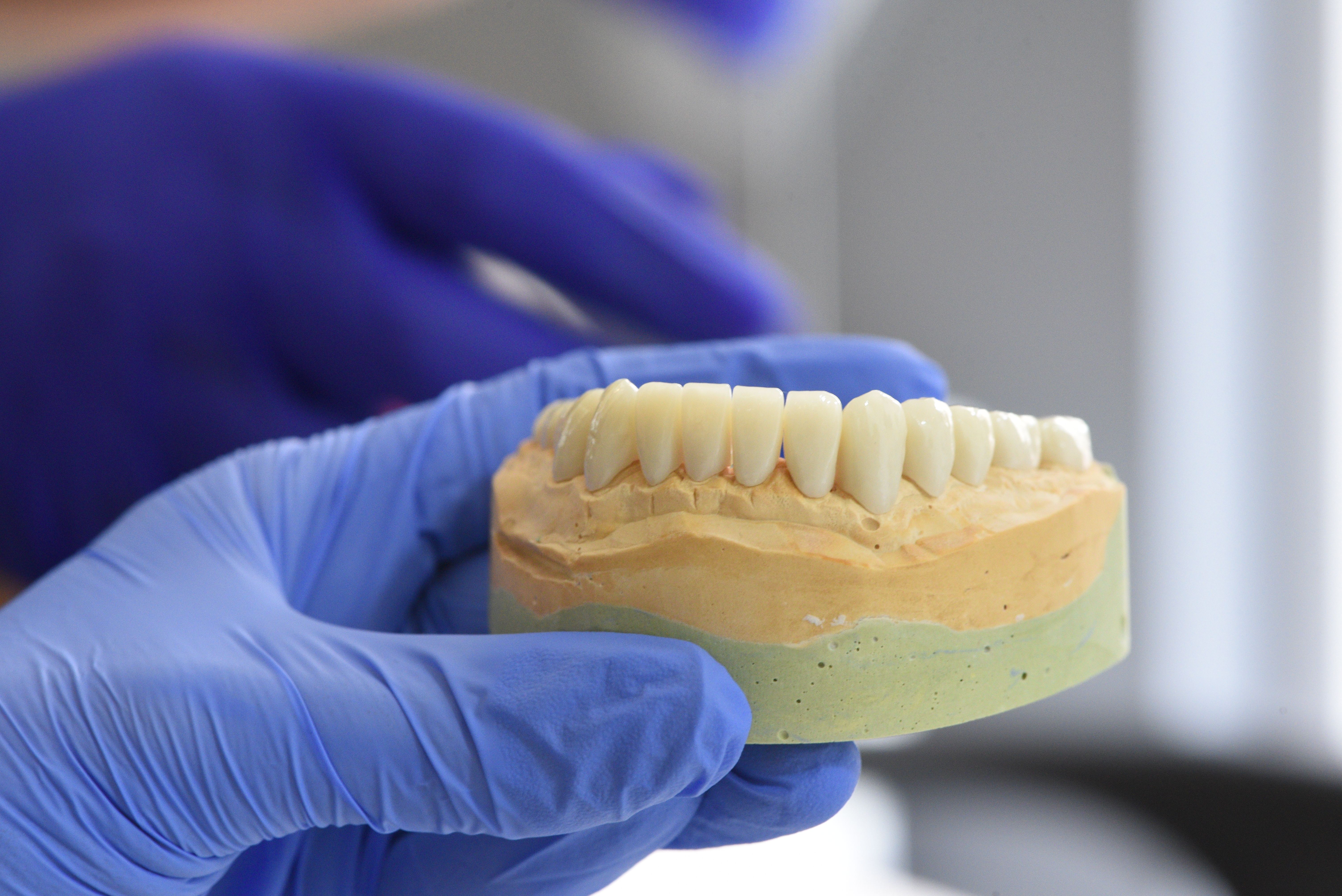 Zirconia vs. Lithium Disilicate (E.max): Which Material Should You Choose?