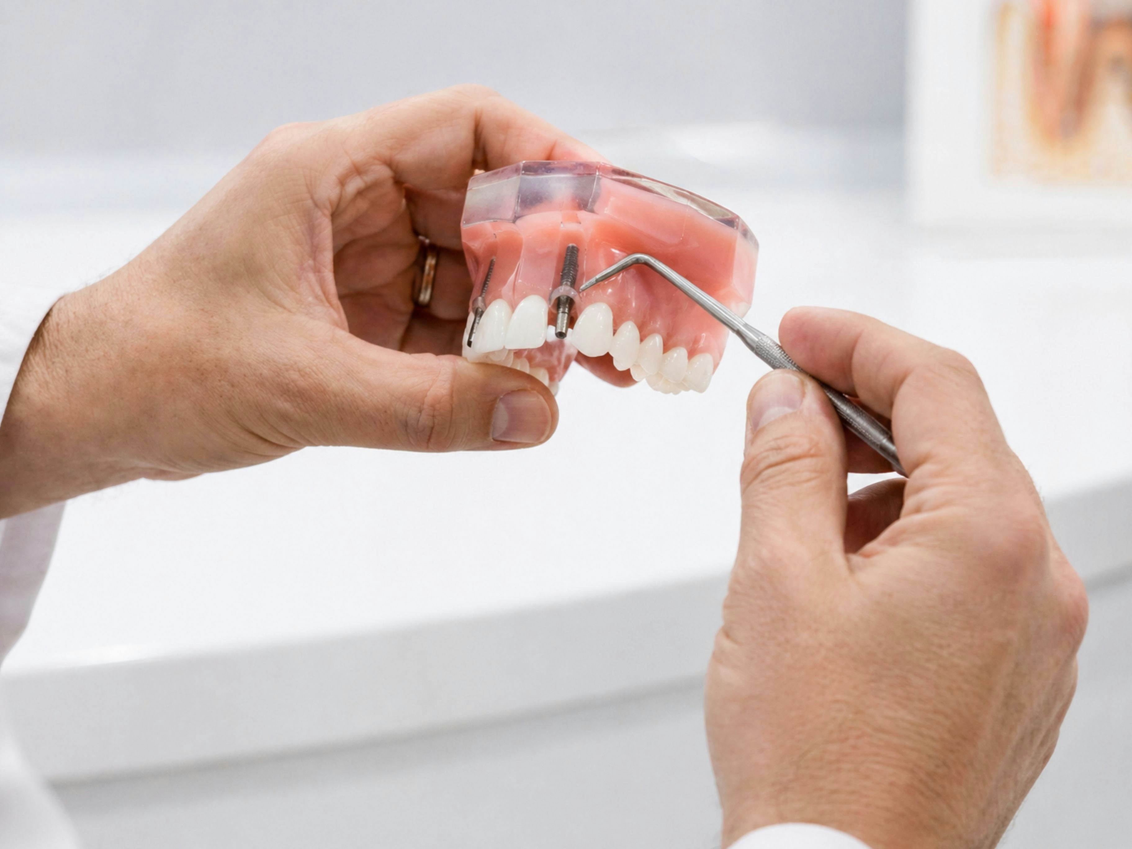Dental Implant Infections May Be Driven by Titanium Particles, New Study Finds
