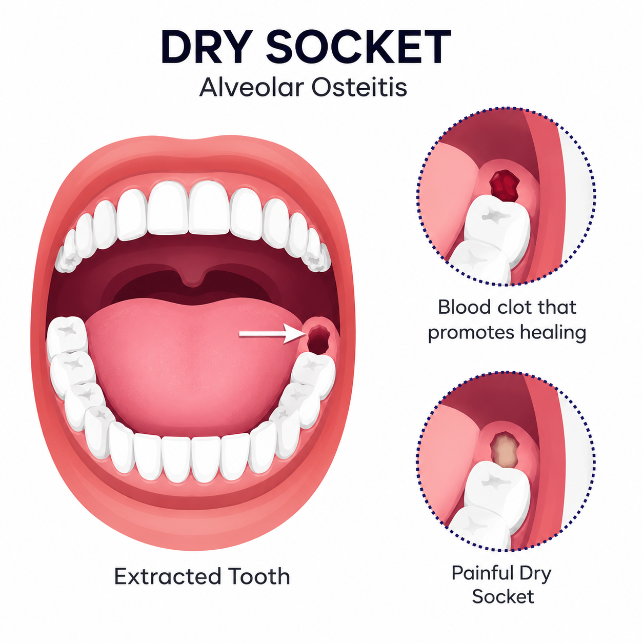 Dry socket in a mouth